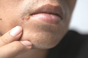 herpes