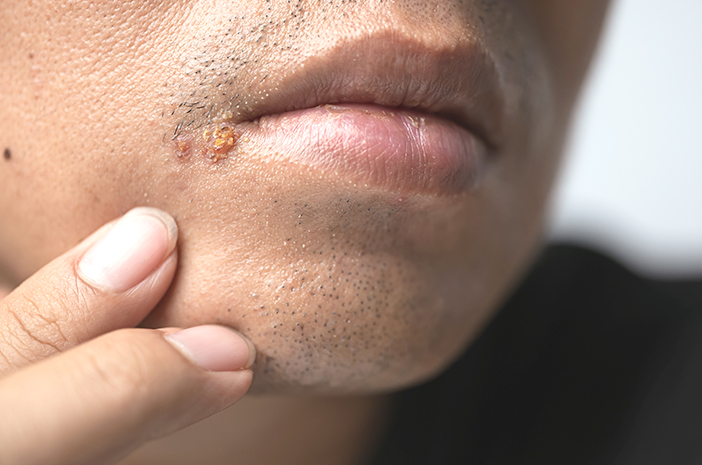 Herpes: Virus yang Mengintai dan Bisa Kambuh Kapan Saja