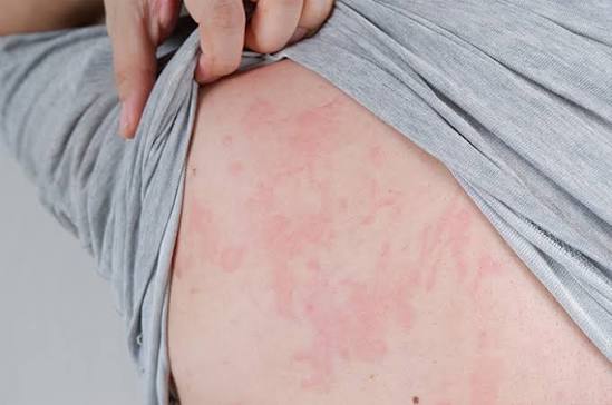 Urtikaria: Waspada dan Lindungi Kulit dari Reaksi Alergi