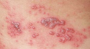 impetigo