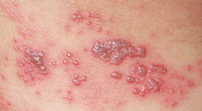 Impetigo: Infeksi Kulit Menular yang Sering Dianggap Remeh