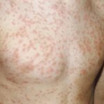 rubella