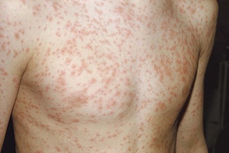 Rubella: Si Campak Jerman yang Sering Dianggap Remeh