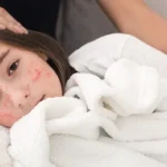 Measles