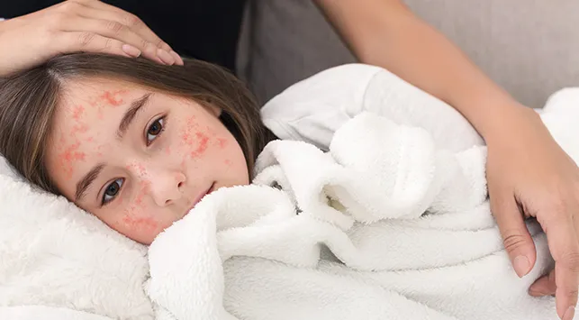 Measles: Penyakit Lama yang Masih Mengintai Anak-Anak